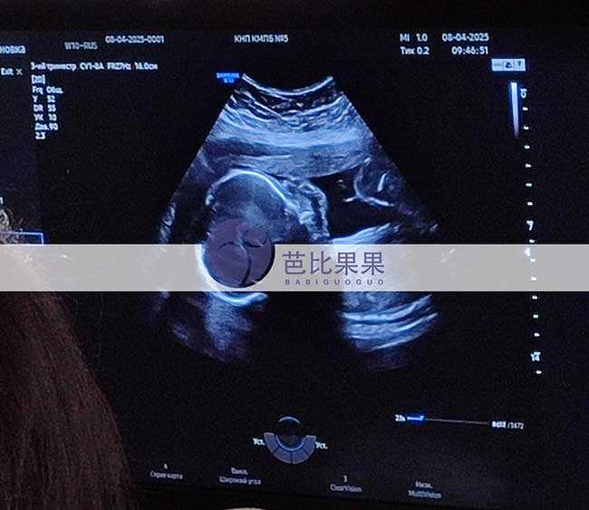 试管妈妈做四维彩超