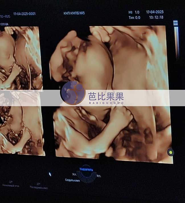 乌克兰试管妈妈做四维彩超