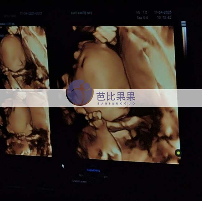 乌克兰试管妈妈做四维彩超