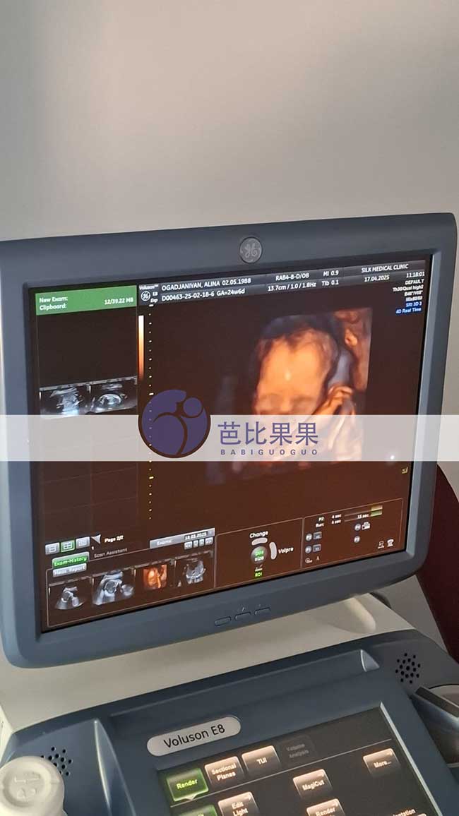 格鲁吉亚试管妈妈做B超