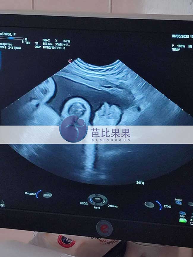 试管妈妈做四维彩超