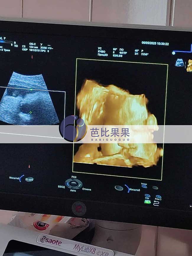 试管妈妈做四维彩超