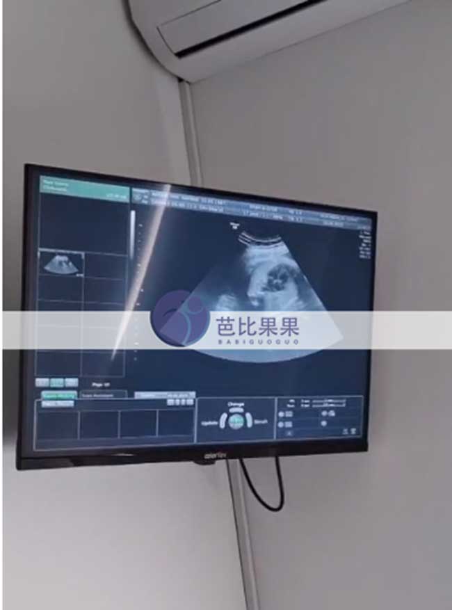 试管妈妈做B超