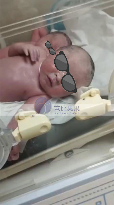 郑先生在格鲁吉亚的双胞胎试管宝宝们剖腹产顺利出生