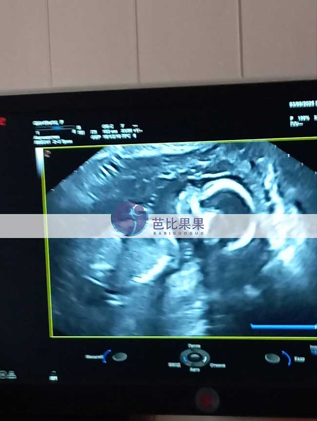 试管妈妈做B超