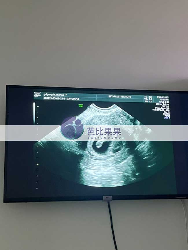 试管妈妈做B超