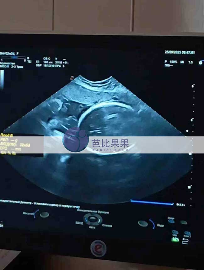 乌克兰试管妈妈做B超