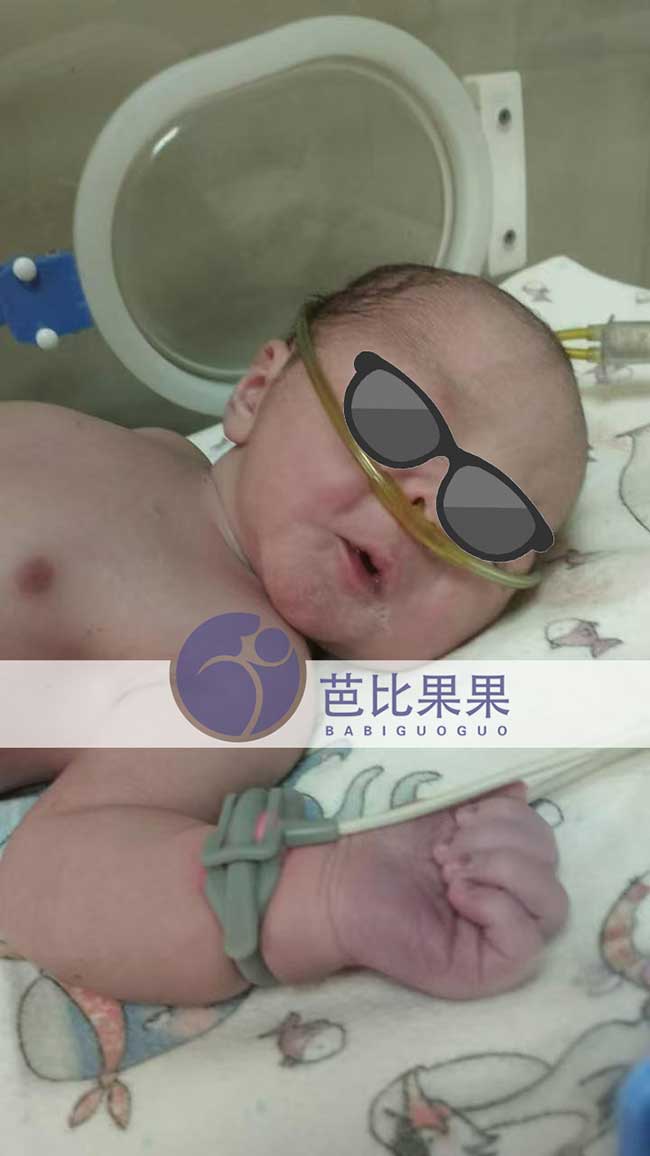 试管宝宝出生