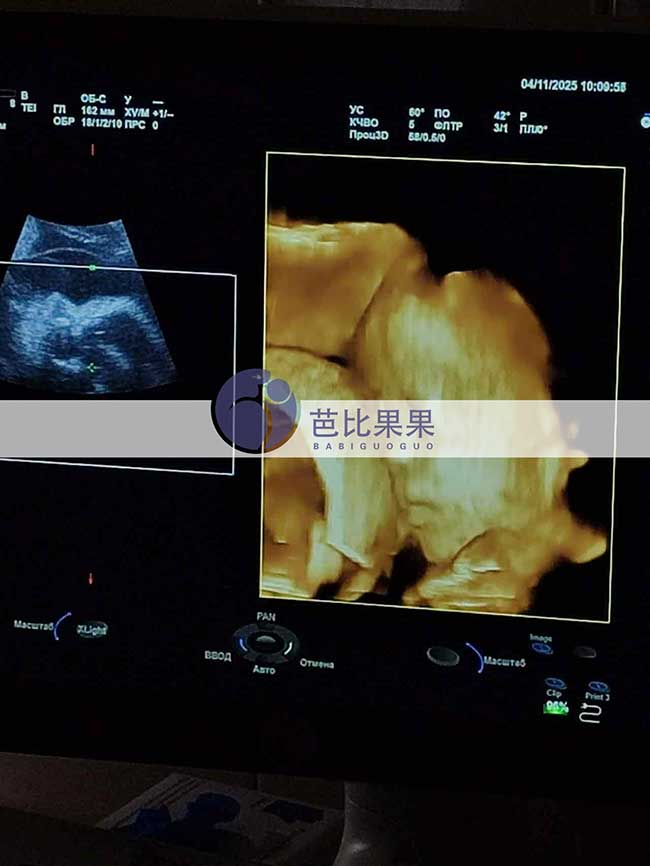 试管妈妈做四维彩超