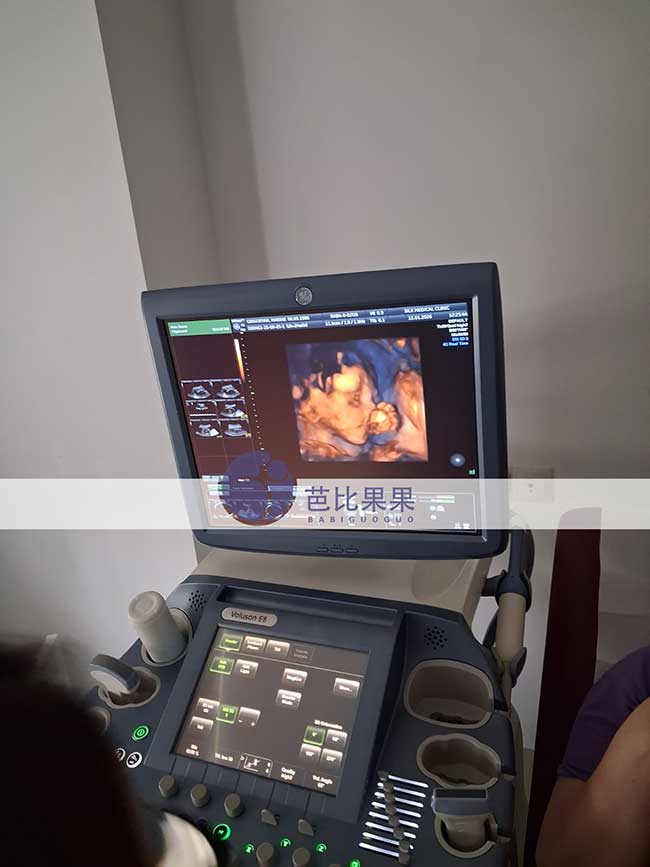 试管妈妈做四维彩超