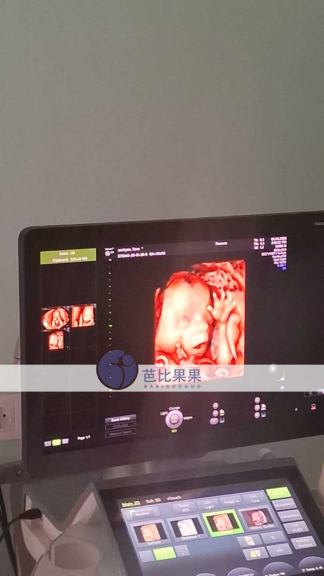 试管妈妈做四维彩超