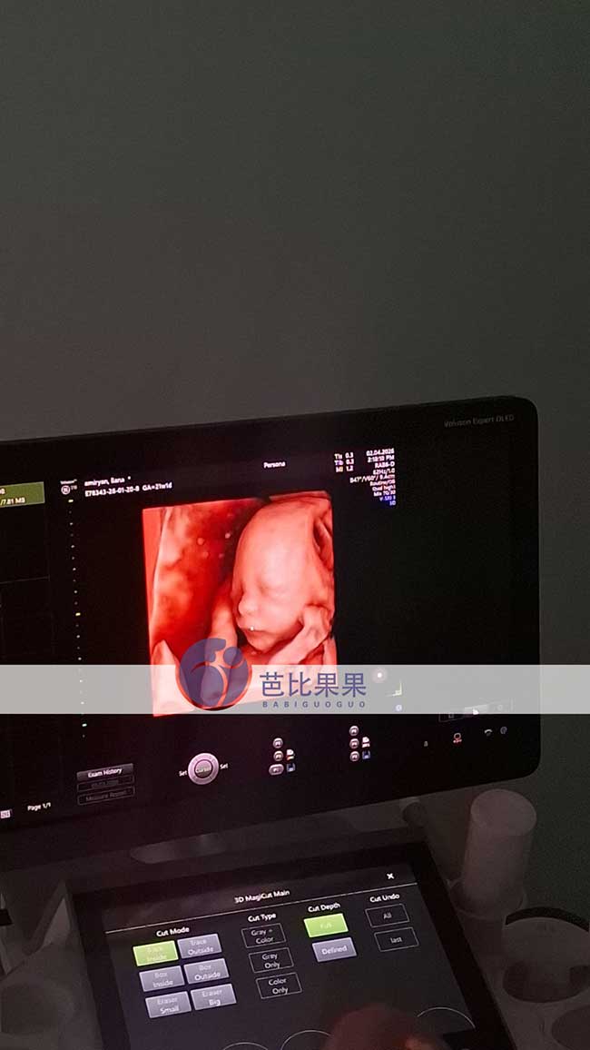 试管妈妈做四维彩超