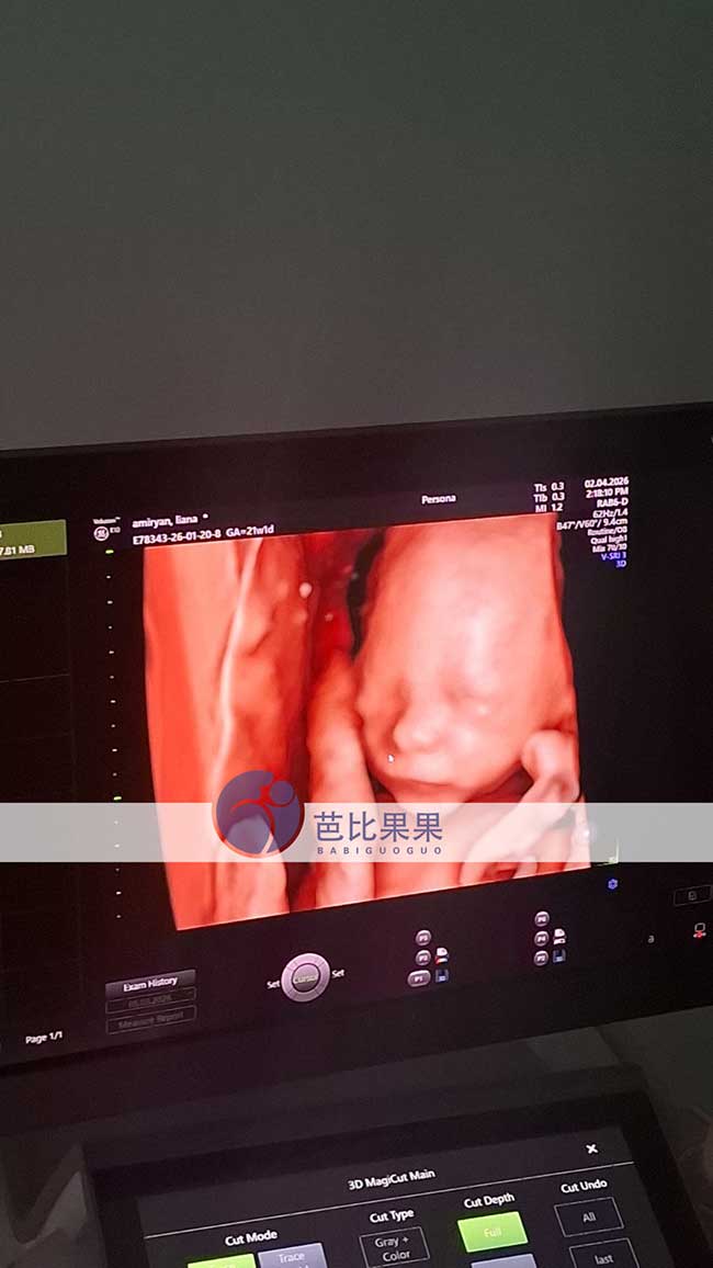 试管妈妈做四维彩超