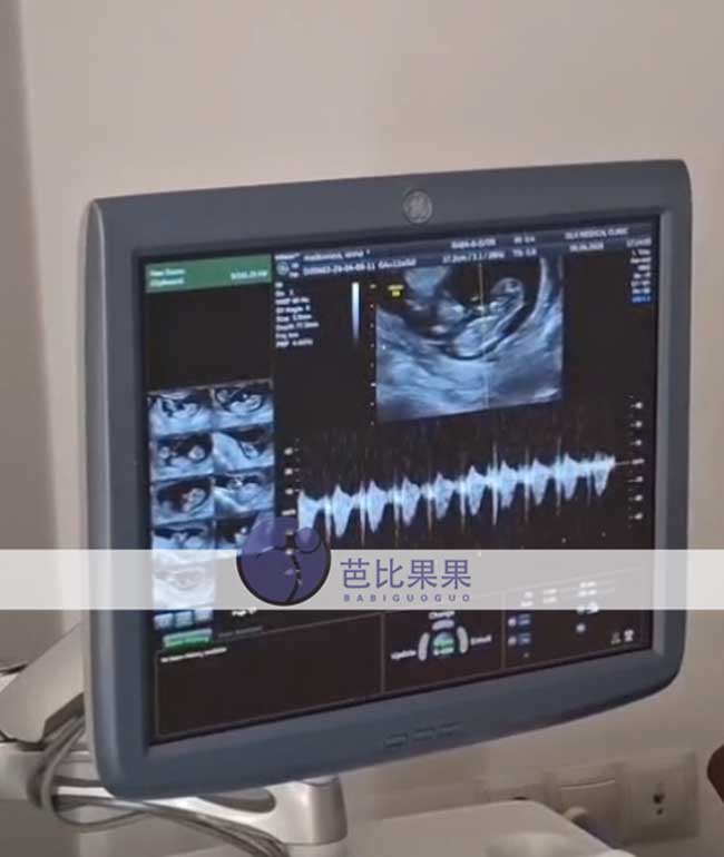 试管妈妈做12周B超