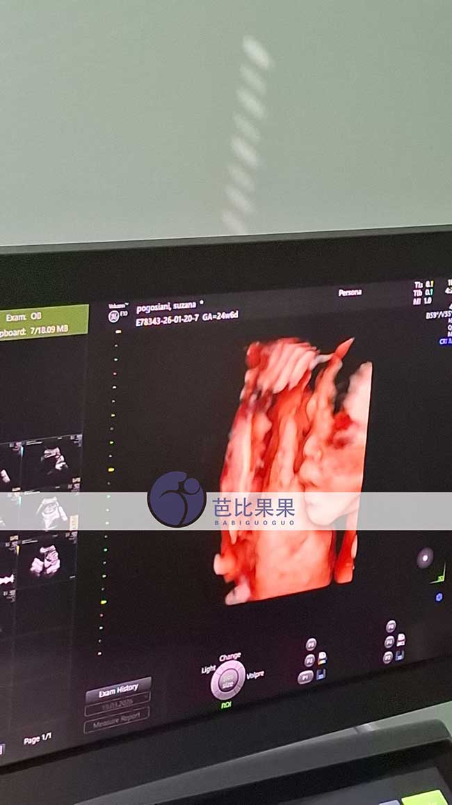 试管妈妈做四维彩超