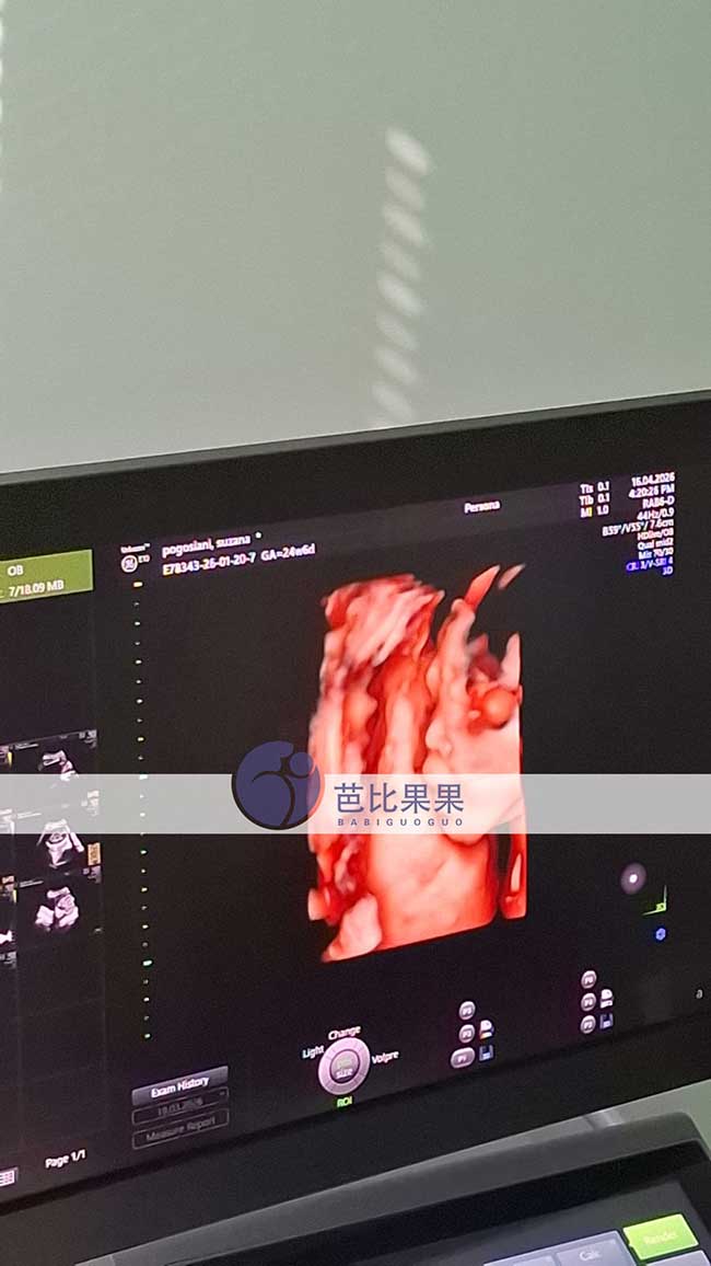 试管妈妈做四维彩超