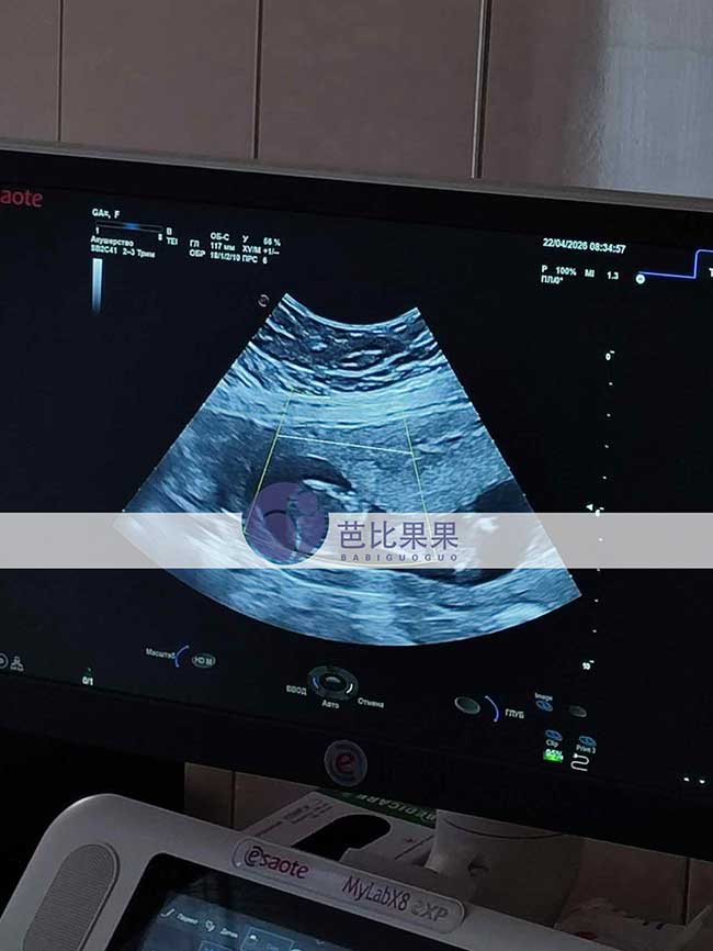 试管妈妈孕12周B超