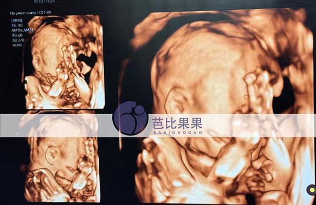 试管妈妈做四维彩超