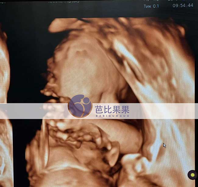 试管妈妈做四维彩超