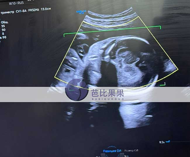 试管妈妈做四维彩超