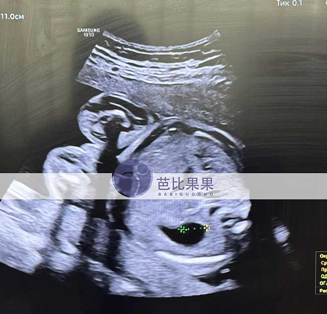 试管妈妈做四维彩超