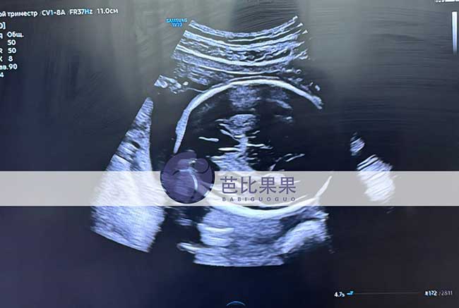 试管妈妈做四维彩超