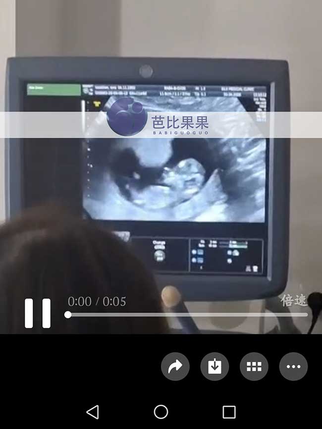 试管妈妈做B超