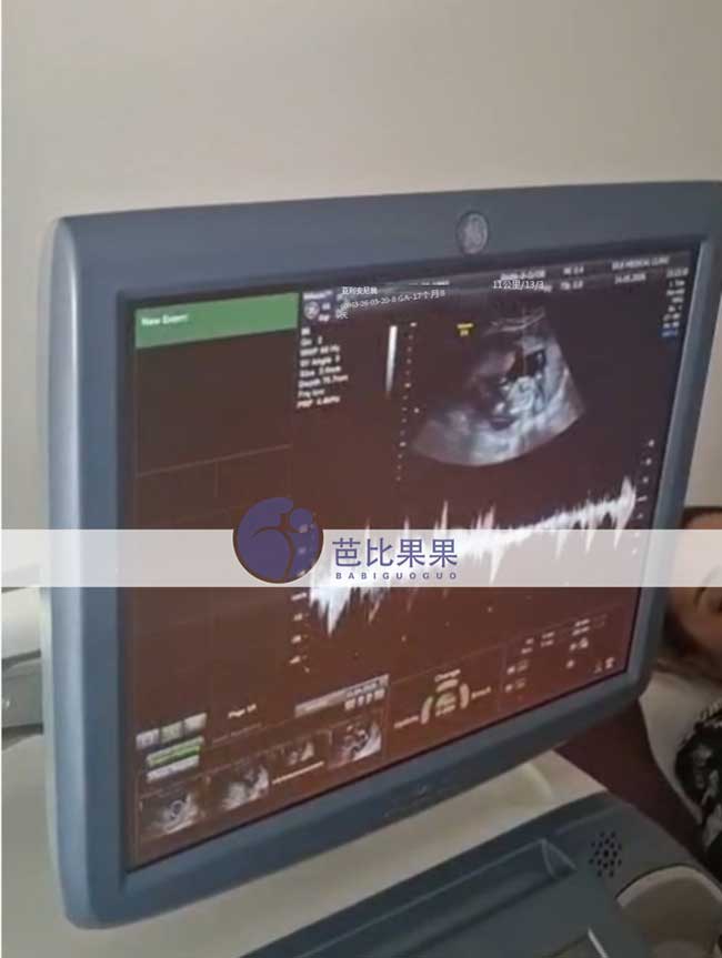 试管妈妈B超复查