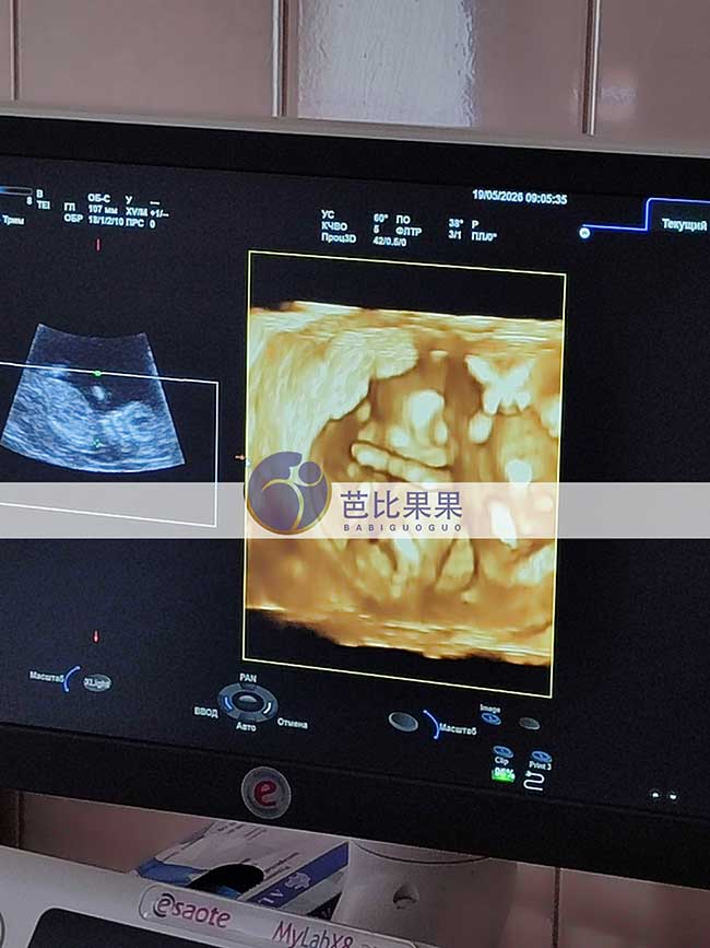 乌克兰试管妈妈12周B超