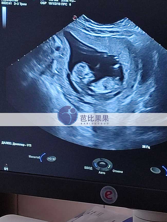 乌克兰试管妈妈12周B超