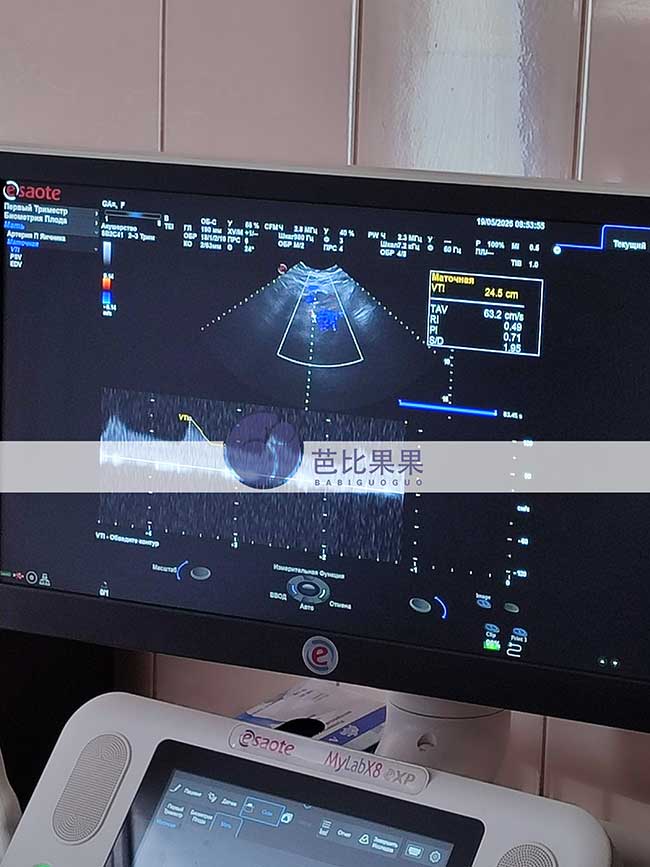 乌克兰试管妈妈12周B超