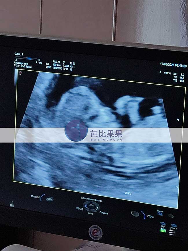 乌克兰试管妈妈12周B超