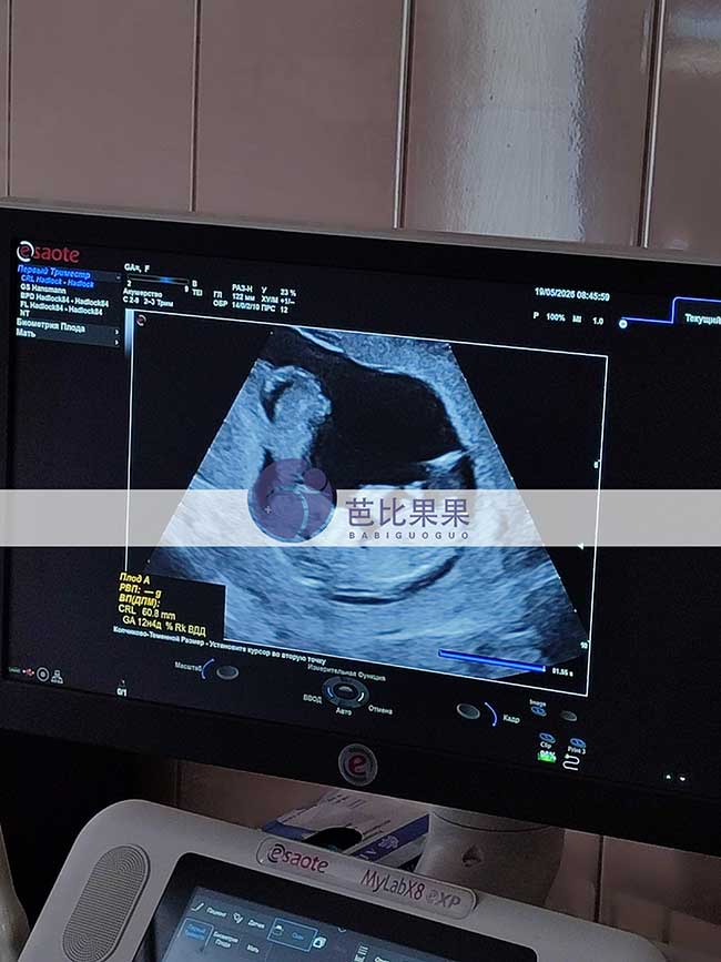 乌克兰试管妈妈12周B超
