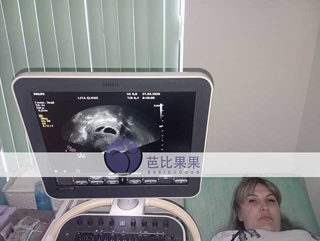 试管妈妈做B超