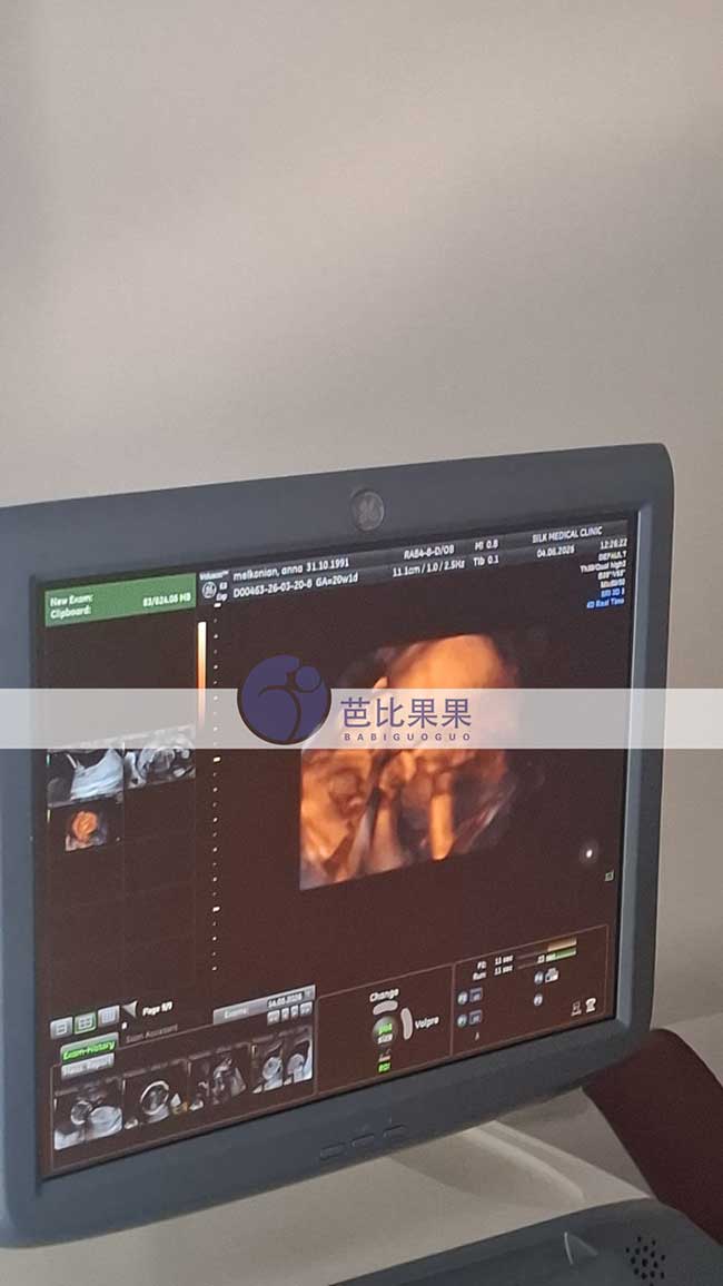 试管妈妈做B超
