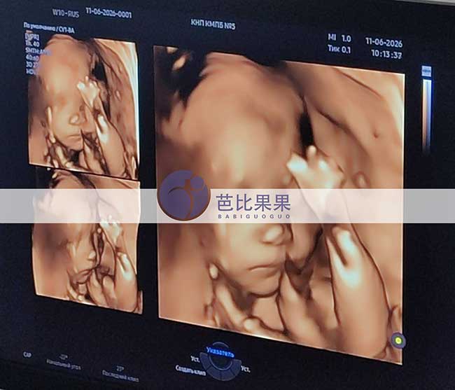试管妈妈做四维彩超