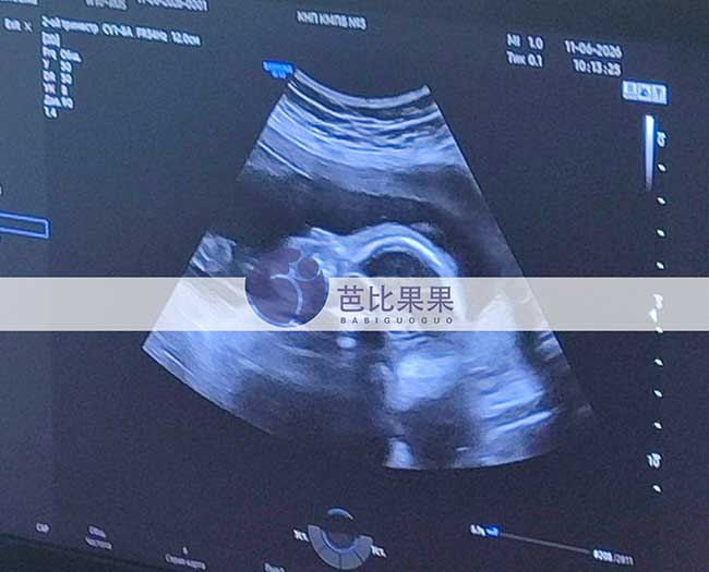 试管妈妈做四维彩超
