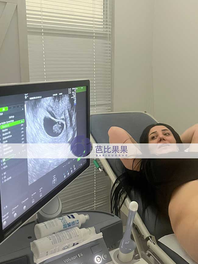 试管妈妈做B超