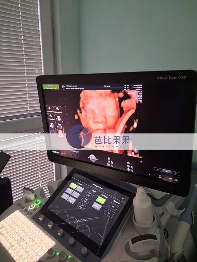 试管妈妈做四维彩超