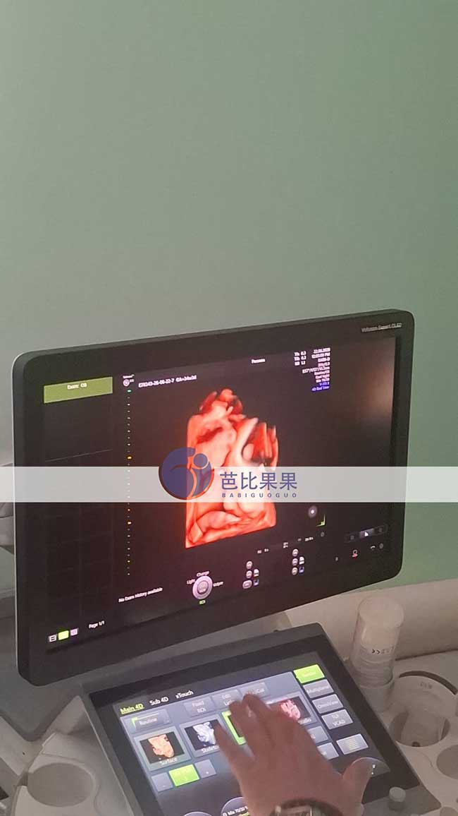 试管妈妈做四维彩超