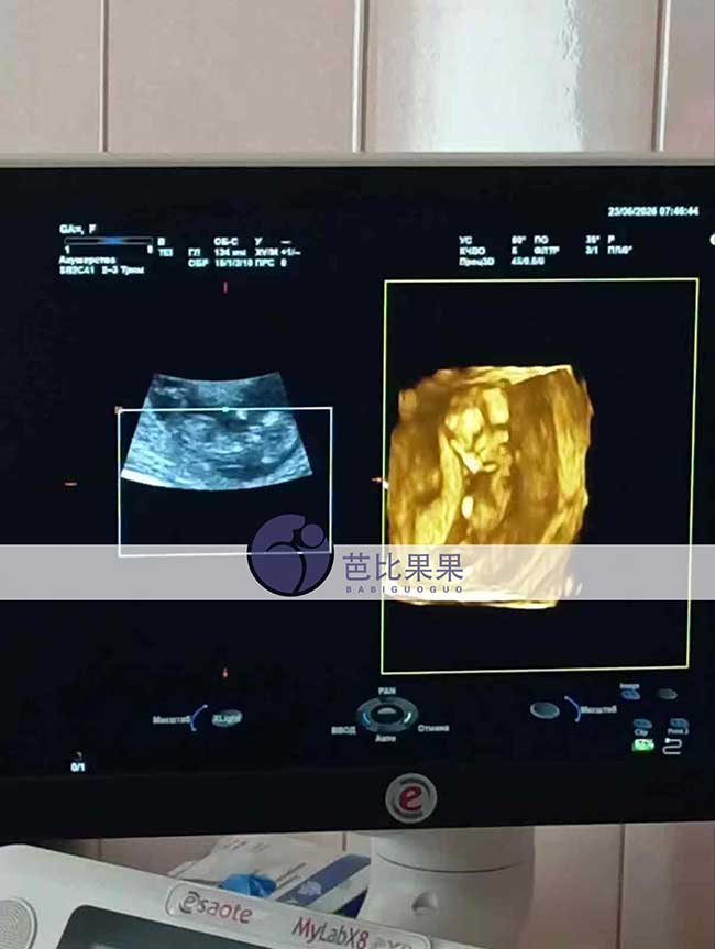 试管妈妈12周B超