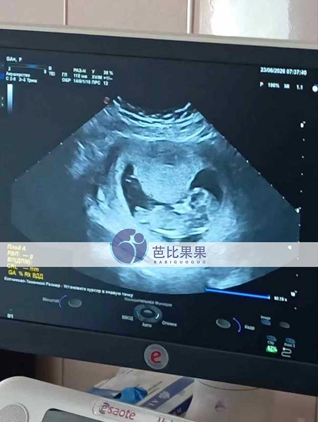 试管妈妈12周B超