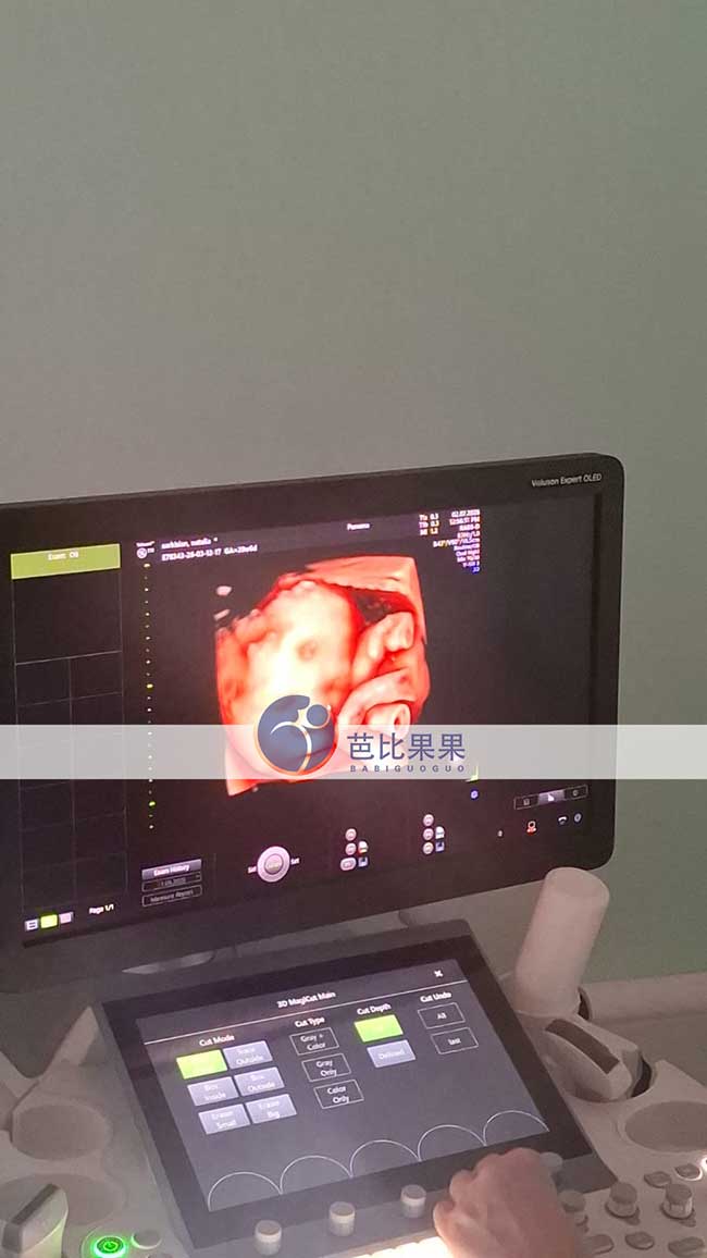 试管妈妈做四维彩超