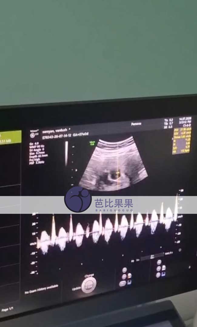 试管妈妈做B超