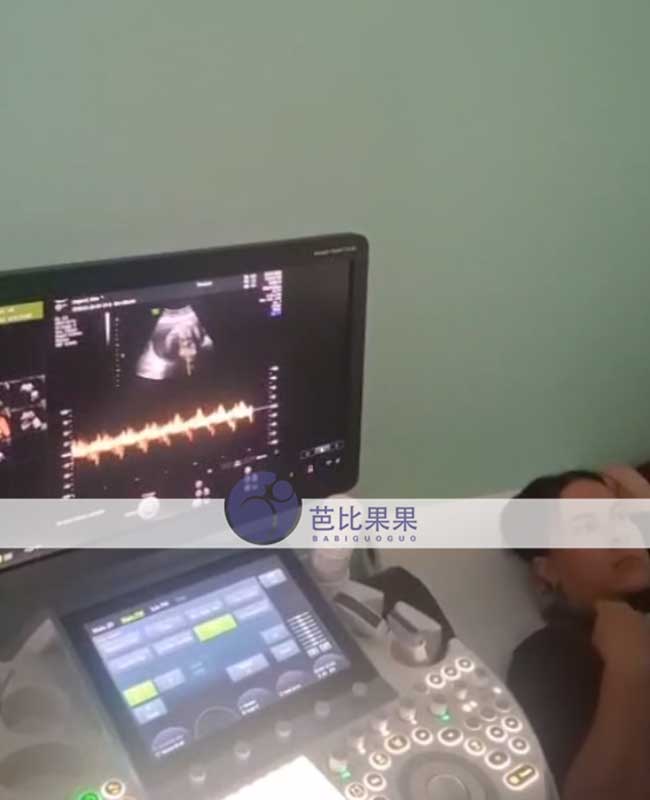 试管妈妈做B超