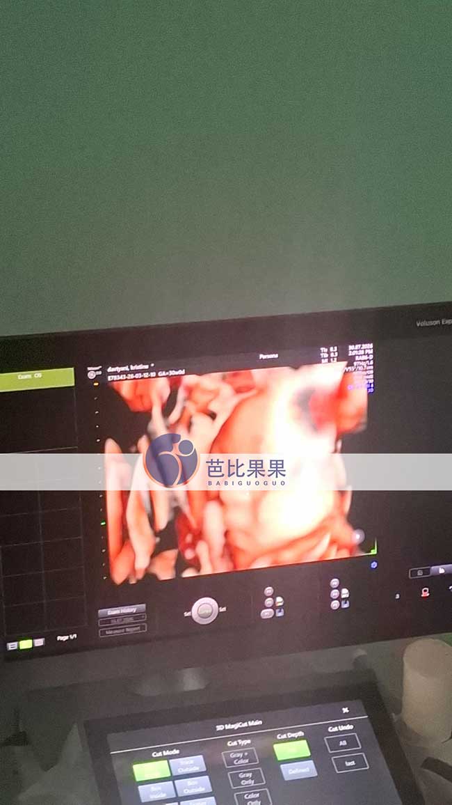 试管妈妈做B超