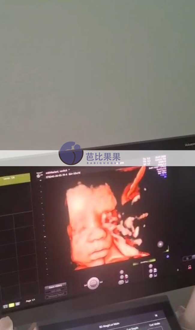 试管妈妈孕32周