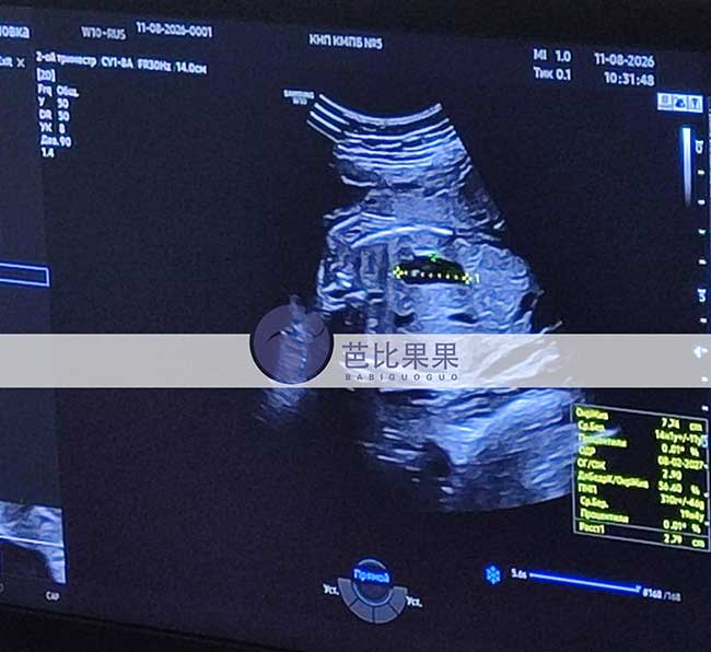 试管妈妈24周B超
