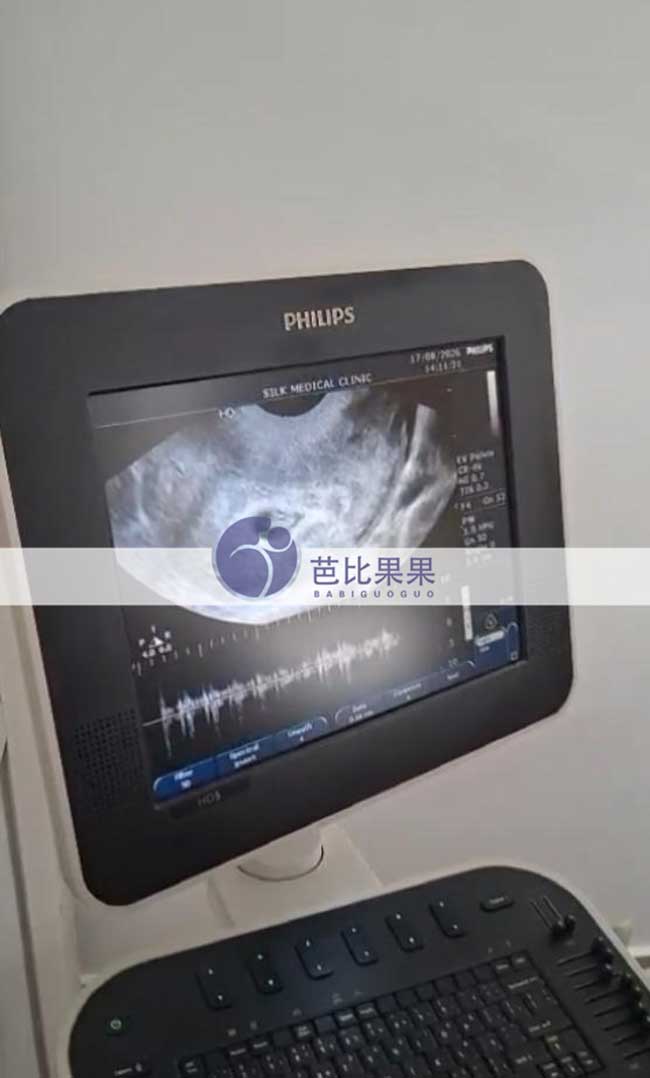 试管妈妈首次B超