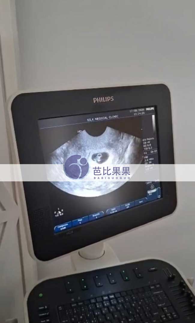试管妈妈首次B超